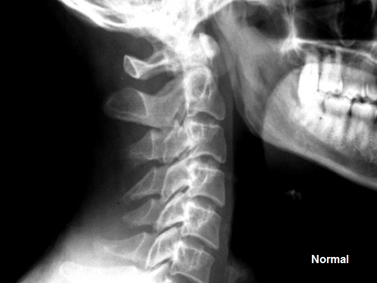 x ray of right lateral cervical spine